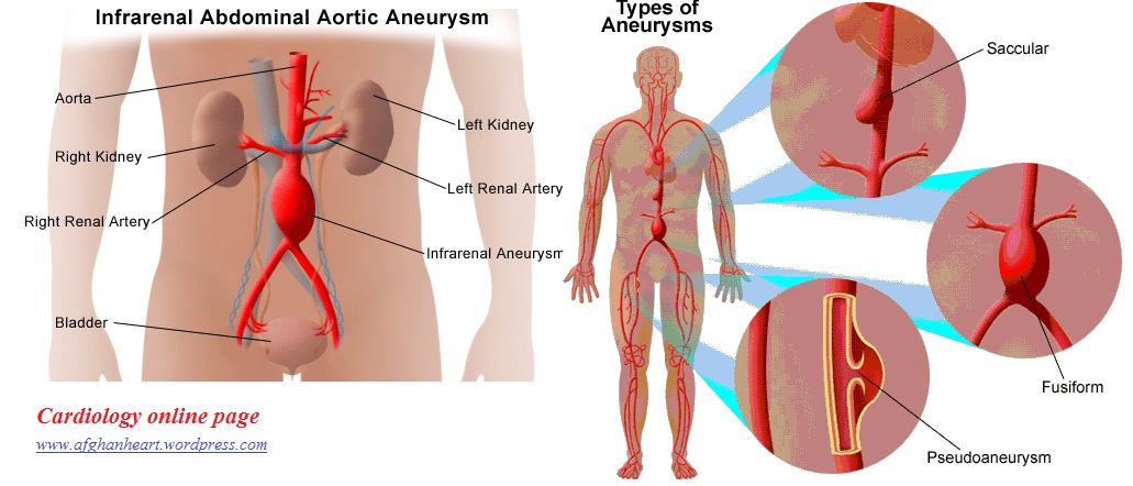 Nonsurgical Procedure For Treatment Of Aaas Abdominal Aortic