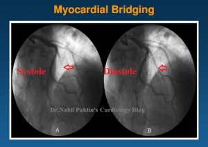 myicardial bridging2